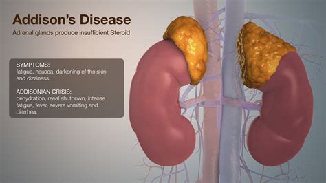 Addison's Disease Explained Using Medical Animation