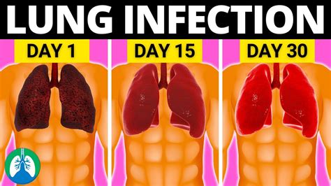 Top 10 Natural Lung Infection Treatments | Sports Health & WellBeing