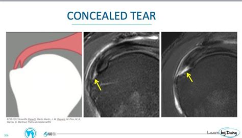 MRI Shoulder Rotator Cuff Footprint Tears - Radedasia