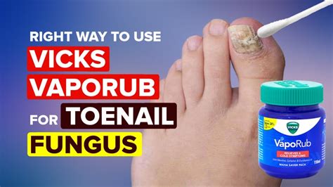 The Right Way To Use Vicks Vaporub for Toenail Fungus - Toenail Fungus ...