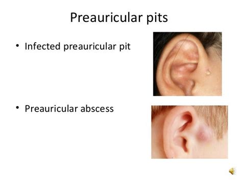 Branchial Remnants and Branchial Cyst