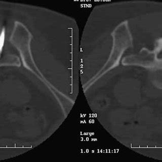 Post-procedure CT image showing near complete filling of the right... | Download Scientific Diagram