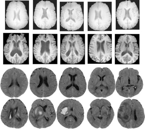 Examples of "Normal" and "Abnormal" images. Brain MRI images in the... | Download Scientific Diagram