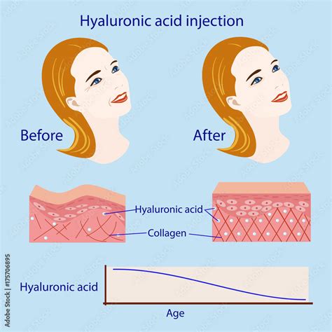 hyaluronic acid injection, before and affect , vector illustration ...