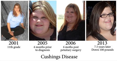 A Little Less Mommy: Cushing's Disease