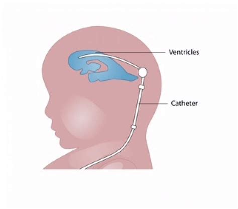 Paediatric CSF shunt complications - Critical Care Collaborative
