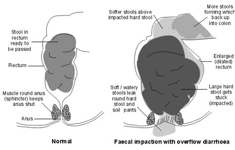 Pin on Constipation