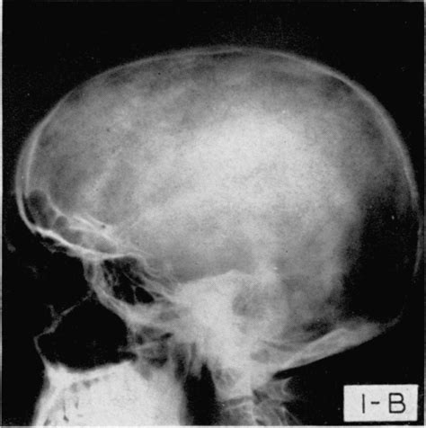 Platybasia: Report of Two Cases. | Open-i