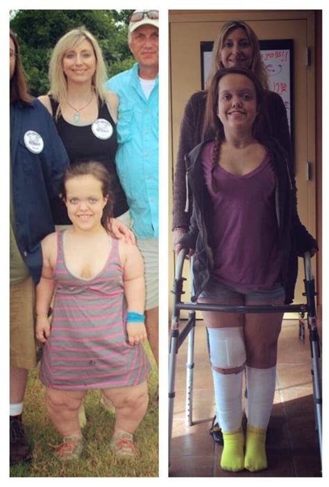 Before and After Limb Lengthening | Before and After limb lengthening for achondroplasia | Pinterest