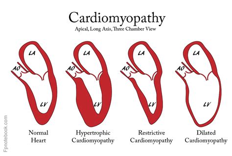 Cardiomyopathy