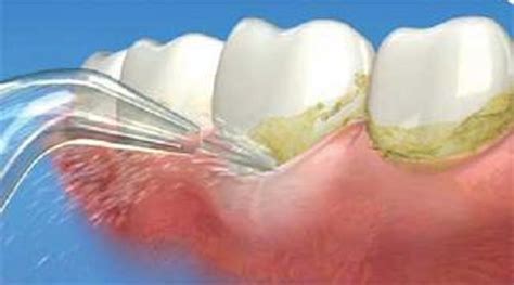 Biofilm Removal | Registered Dental Hygienists