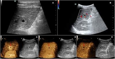 Frontiers | Contrast-Enhanced Ultrasound Findings of Hepatocellular ...