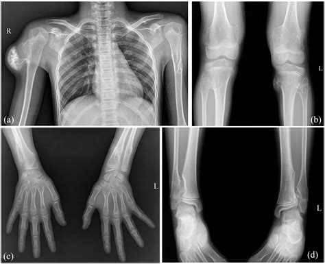 Hereditary multiple exostoses: A case report and literature review - Thi Hien Ha, Thi Minh Thi ...