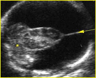 Hydranencephaly Ultrasound