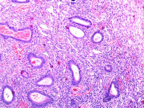 Cervical polyp prepared slides of human pathology - Xinxiang Happy ...