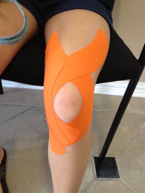 Knee Taping For Patellar Dislocation | www.imgkid.com - The Image Kid Has It!