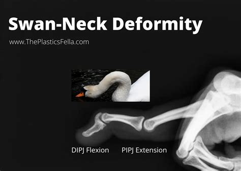 Swan Neck Deformity vs Boutonnières