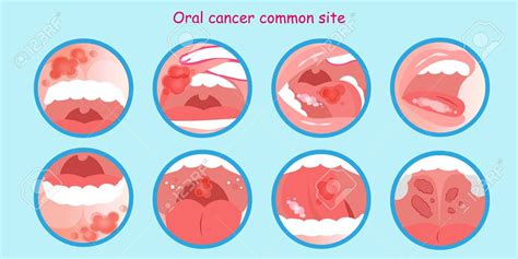 Mouth Cancer | Teodora Todorova