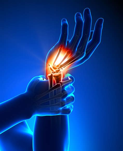 Nerve pain in Hand: Causes & Symptoms of Nerve pain - Hand therapist