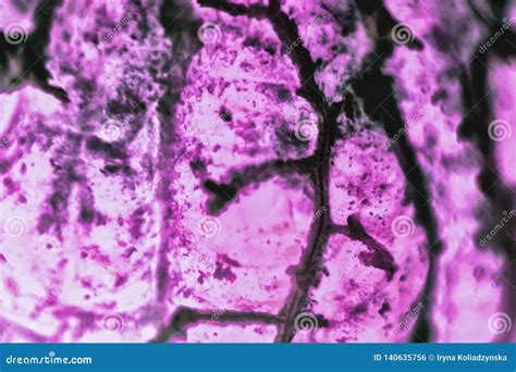 Human Squamous Cell Carcinoma. Tissues Affected by Cancer Cells Under a Microscope Stock Photo ...