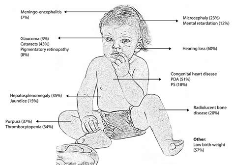 Congenital rubella causes, symptoms, diagnosis & treatment