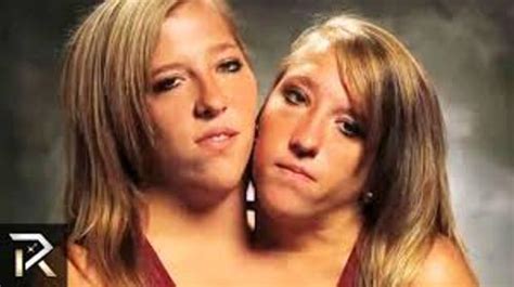 10 Facts about Conjoined Twins - Fact File