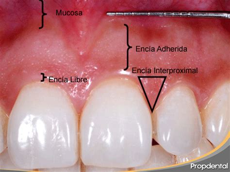 Encía adherida y queratinizada | Precio tratar encías inflamadas