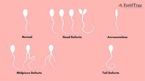 Teratozoospermia: Types, Diagnosis & Treatment | FertilTree