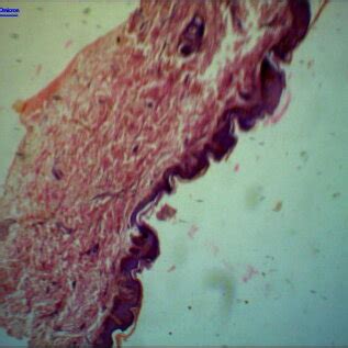 Histology of lichen nitidus – psoriasiform hyperplasia present. | Download Scientific Diagram