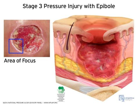 NPTE 2019 Changes: Integumentary Pressure Injury Classifications