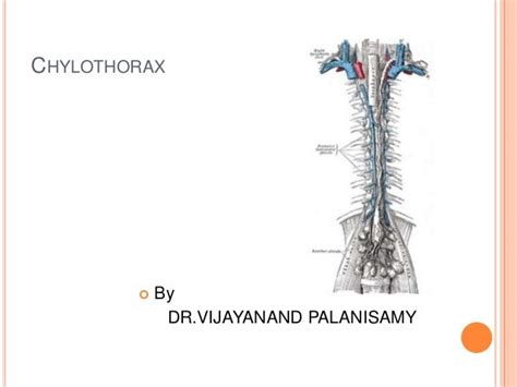 Chylothorax