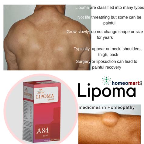 Top Lipoma treatment and removal medicines - Homeomart Blog