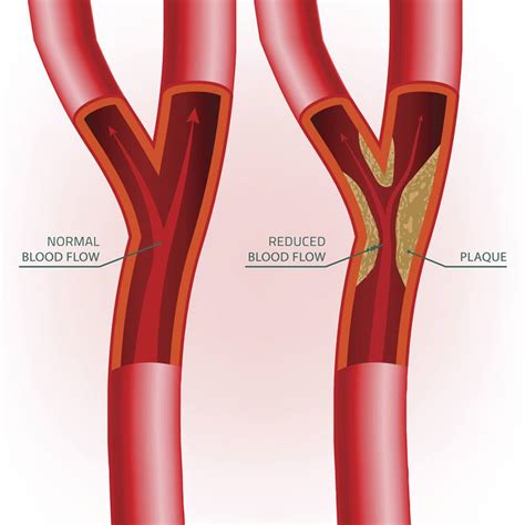 Major Study of Atherosclerotic Plaque Deposits Shows Potential ...