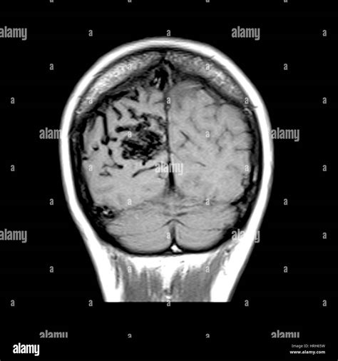 MRI of Arterial Venous Malformation Stock Photo - Alamy