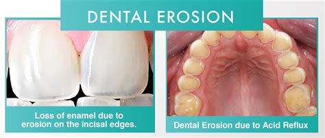 Dental Erosion and Dental Abrasion | 32 Smile Design – Dental Clinic