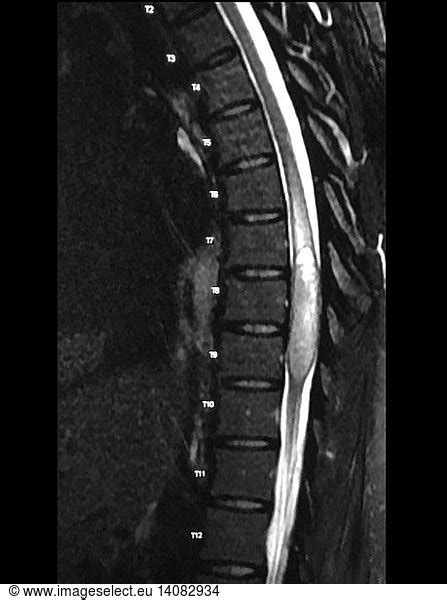 Thoracic Spinal Cord Ependymoma Thoracic Spinal Cord Ependymoma, MRI,abnormal,abnormality ...