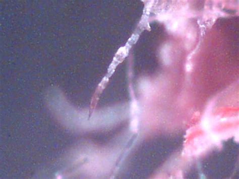 Morgellons Disease symptoms - Morgellons Disease