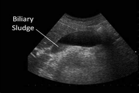 What is Gallbladder Sludge? | Gallbladder, Treatment, Symptoms