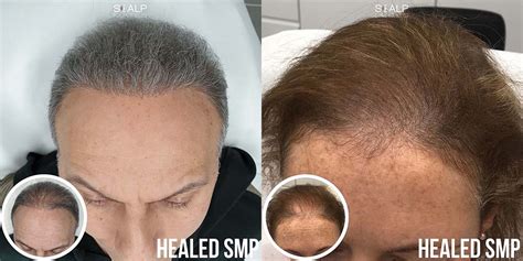 Scalp Micropigmentation SMP for Long Hair in Birmingham UK | Results & Process