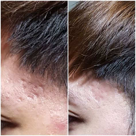 3 weeks post microneedling at home - Scar treatments - Acne.org