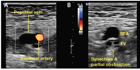 Duplex Ultrasound Technical Considerations for Lower Extremity Venous ...