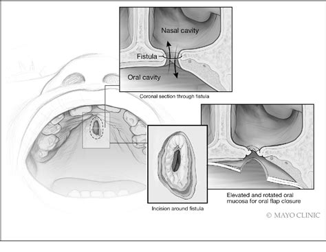 Figure 2 from Triple Layer Oronasal Fistula Repair Using Local Endonasal Flaps: Case Series of ...