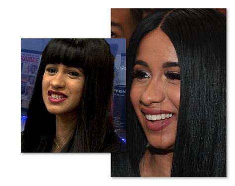 Cardi B Teeth Before And After Old Smile Vs New