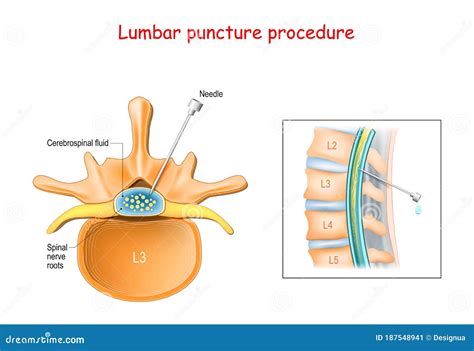 Lumbar Puncture Or Spinal Tap Procedure Medical Poster With Human Vertebral Column And Syringe ...