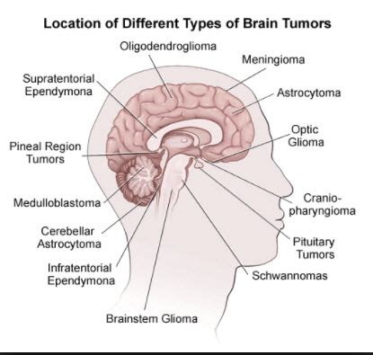 Brain Tumors Now Accessible With New Chemo Delivery System | Elmwood Hills Healthcare Center Blog