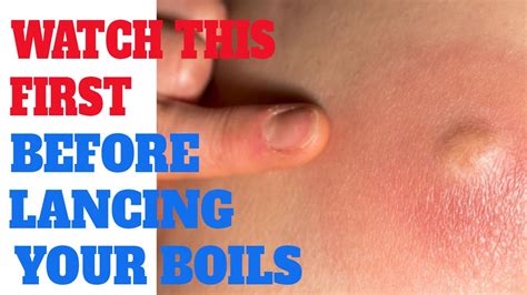 Lancing a boil | What You should do before lancing a boil | How to ...