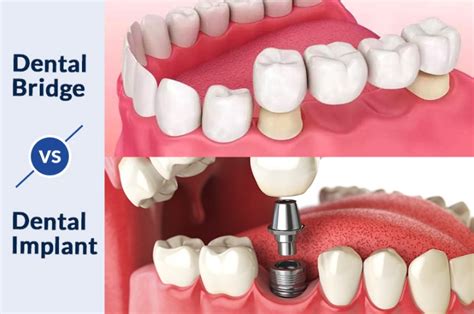 Parramatta Dentistry: Which Is Better? Bridge Or Implant?