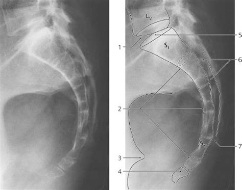 sacrum x ray - Google 搜尋 | X ray, Celestial, Outdoor