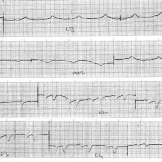 ECG of a female patient presenting with atypical chest pain, showing... | Download Scientific ...