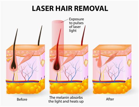 Laser Hair Removal FAQs | Pure Vanity Spa, Arizona